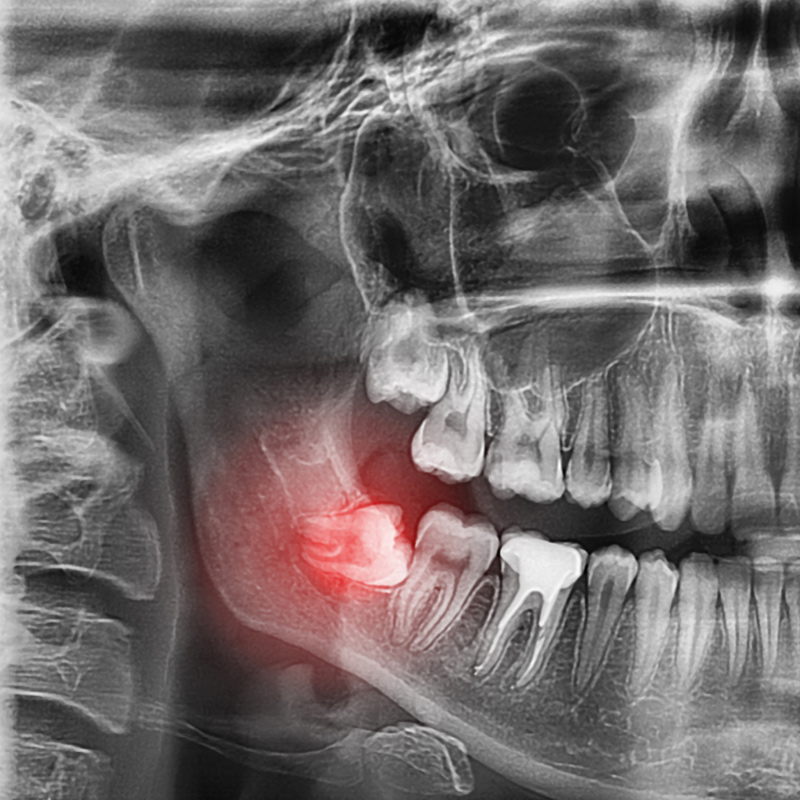 Stomatologica Services - Pronto Soccorso Dentistico - Problemi dente del giudizio