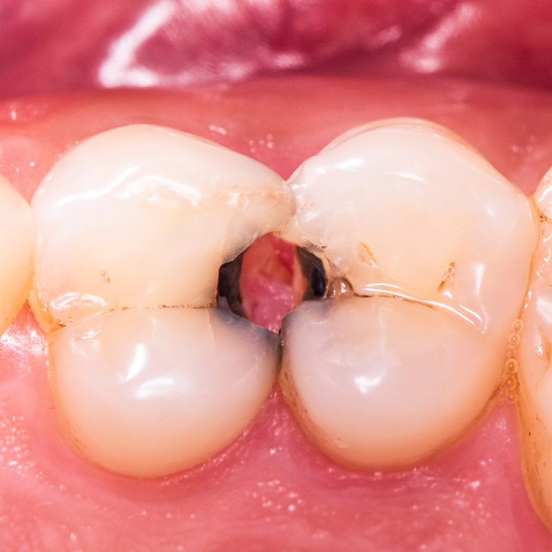 Stomatologica Services - Pronto Soccorso Dentistico - Pulpite